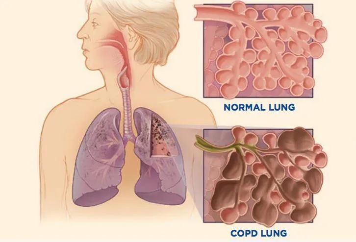 The role of Ventilator and Oxygen concentrator for COPD Patients - COXTOD